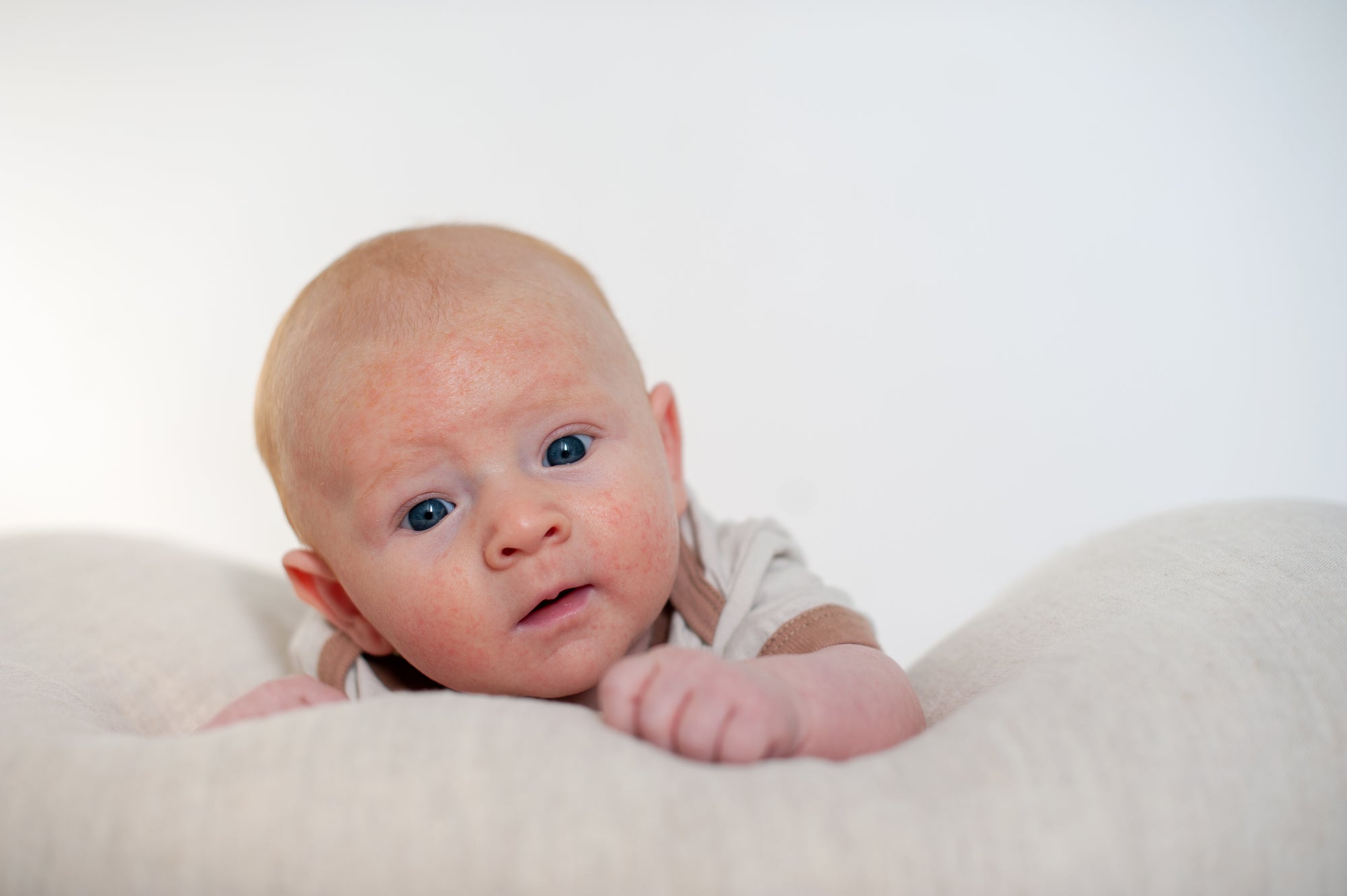 Acne on baby face