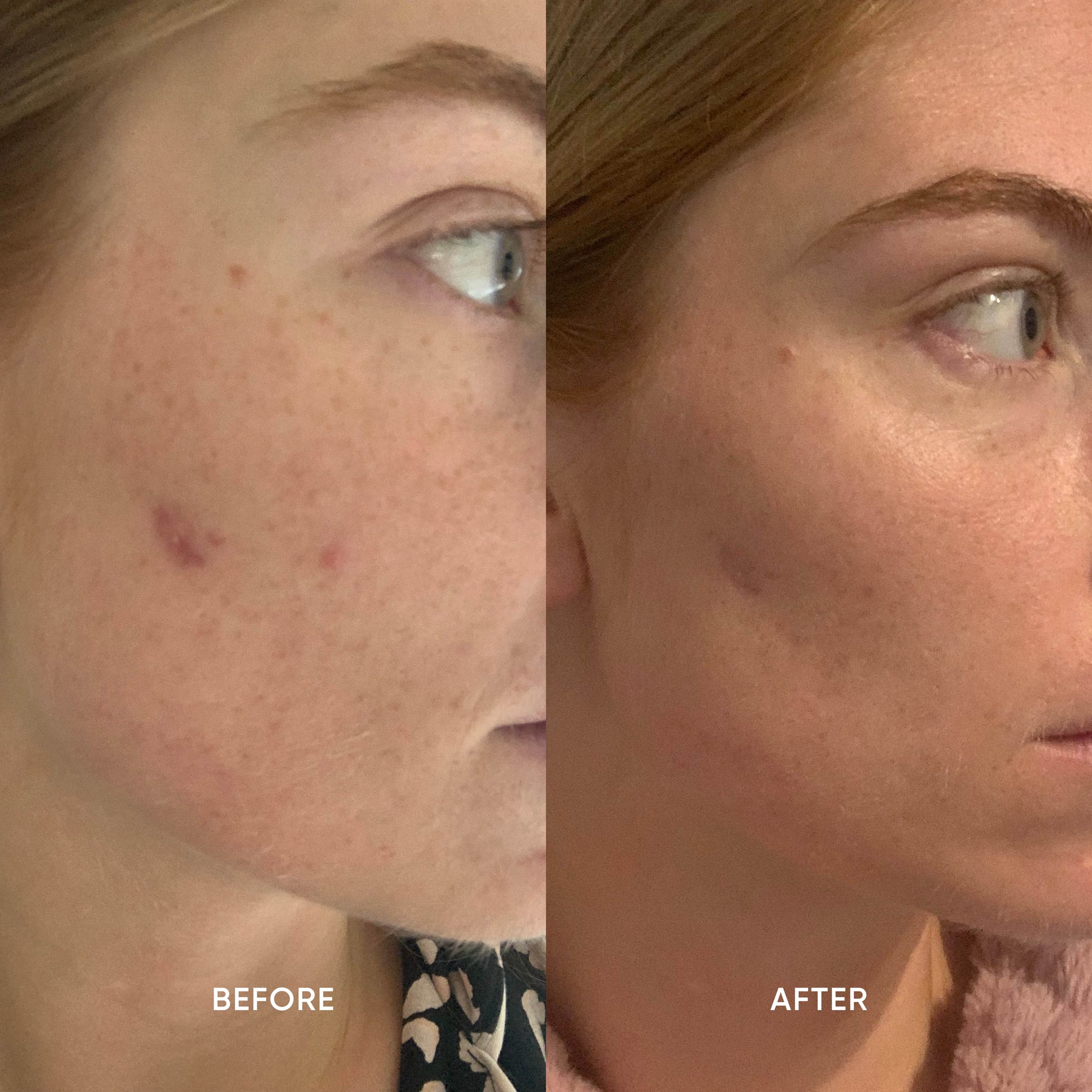 Before and after images from use of ManukaRx Rejuvenating Mānuka Oil Exfoliant